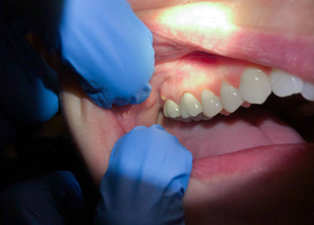 Best Dentist for Tooth Abscess  in Hewitt, NJ